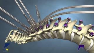 Correcting Kyphosis with the MESA Rail™ Deformity Spinal System