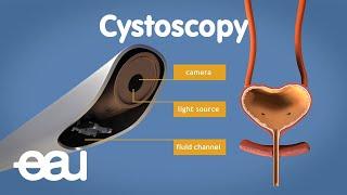 Cystoscopy (overactive bladder)