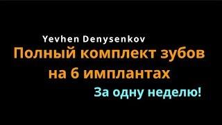 Зубы на 6-ти имплантах за одну неделю, полная имплантация зубов или полная потеря зубов.