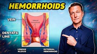 The #1 Best Remedy for Hemorrhoids - Dr. Berg