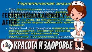 Герпетическая ангина у детей