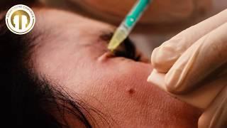 Lachfalten Botox | vom Privatdozenten behandelt | Mc Aesthetics