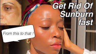 Get Rid of Sunburn Fast | Natural At home remedy