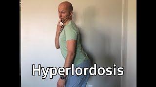 Hyperlordosis and Rib Flares