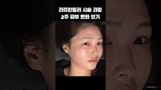 리쥬란힐러 시술 과정 ~ 2주 피부 변화 