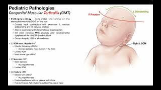 Torticollis → Mechanism, Pathophysiology, & Effects in Infants