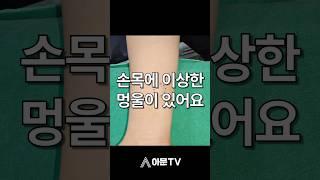 손목에 있는 이상한 멍울의 정체는?!(성형외과 손목 멍울 낭종 표피낭종 피지낭종 나선선종 수술 출혈 압출 후기)[아문TV]