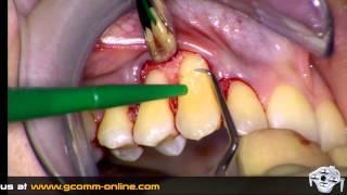 Implatech IRIS VIEW - Video 1