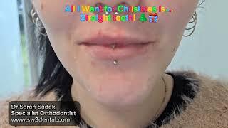 All I want for Christmas is Straight Teeth!  Patient Testimonial