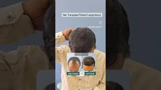 Elite signature superdense Hair Transplant patient's satisfactory experience