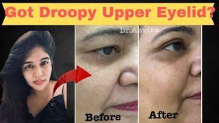 Get young with upper Eye lid Surgery. // dr. anvika // 9999 747 717