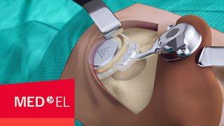 BONEBRIDGE BCI 602 Implant Surgery | MED-EL