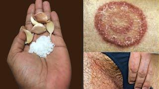 How to treat ringworm fast || Homemade remedy for skin fungal infection