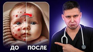 Как БЫСТРО избавиться от акне новорожденных?