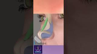 Augmentation Rhinoplasty Surgery 3D animation