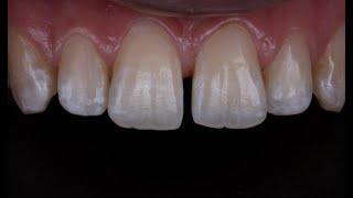 Direct compoSite veneers demo using simplified approach with unica matrix