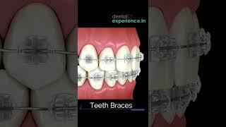 Affordable | Metal braces | Ceramic Teeth Braces | Clear Teeth Aligners Cost in Kochi, Kerala, India