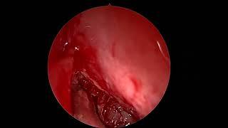 UNILATERAL FUNCTIONAL ENDOSCOPIC SINUS SURGERY (FESS) - DR. VINAY S BHAT