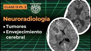 13.3 -  Neuroradiología: Tumores y envejecimiento cerebral