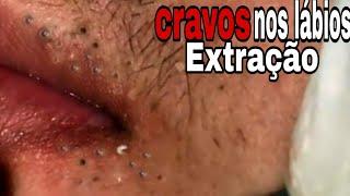 Removendo CRAVOS dos labios-SATISFATÓRIO - cravos na boca 