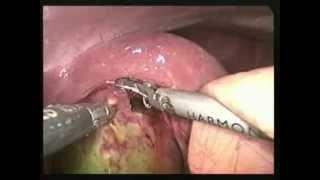 LAPAROSCOPIC CHOLECYSTECTOMY FUNDUS FIRST TECHNIQUE FOR GANGRENE GALLBLADDER@drimranhussain com