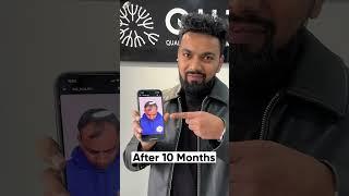 Ten Months Hair Transplant Results | Latest Fue Technique #shorts #viral #hair transplant