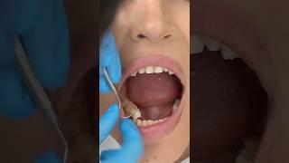 This is how we do Porcelain Veneers | Cosmetic Dentist in Istanbul #Dentakay #shorts