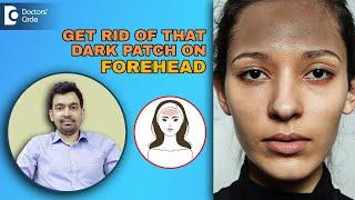 Get Rid of Black/Dark Forehead  | Pigmentary Demarcation Lines- Dr.Rajdeep Mysore | Doctors' Circle