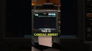 Ventricular Tachycardia to Fibrillation