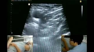 1.(의사용.Technique) US-guided NB for Regional anesthesia in Lower extremity surgery [강찬.충남대]