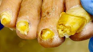 Super Thick Onychomycosis, Like A Bullet Head, Successfully Trimmed [Doctor Liu Pedicure]