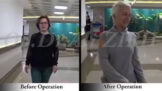 Fatma ATLAS / Before and After Surgery Parkinson's Treatment DBS in Turkey