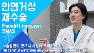 Facelift revision , SMAS, 안면거상 재수술