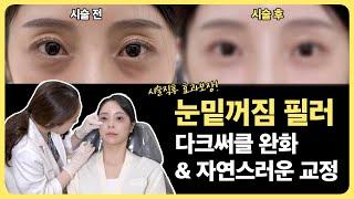 눈밑꺼짐,다크써클이 고민이라면?자연스러운 눈밑필러⏩️시술과정, 디자인, 시술직후 공개