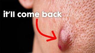 The Real REASON You Can't Clear Your Acne - And How To Fix That