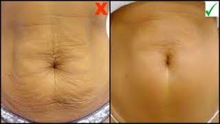HOW TO GET RID OF SAGGING SKIN, TIGHTEN EXCESS LOOSE SKIN FAST |Khichi Beauty