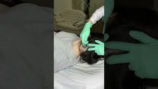 Сделаем курс процедур и будем наблюдать за изменениями #плазмолифтинг #косметологмосква