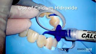 Easy use of Calcium Hydroxide in endodontics