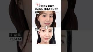 눈밑 꺼짐, 필러 없이 해결?! 레티젠 리얼 후기