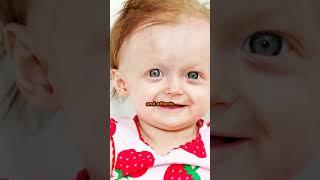 Progeria - genetic disease #progeria #medicine #madmedhistory