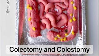 Playdough Surgery - Colectomy (colon removal) and Colostomy Creation - aka Hartmann Procedure