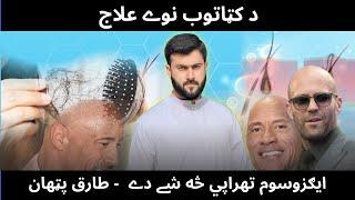 Exosomes therapy for Hair loss / Hair Fall explained by Tariq Pathan