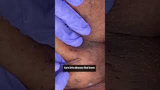 Body treatment on HS client #houstonskincare #houstonesthetician #hidradenitissuppurativa