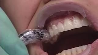 Marisa: A Lumineers Veneers Clinical Case Study - DenMat Dental Education