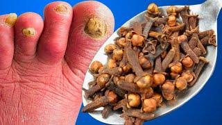 Cure Toenail Fungus For Less Than $0.5 / Have Toenail Fungus? You have to do it