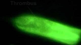 How Thrombosis Develops - Thrombosis Adviser.flv