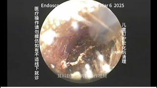 Cleaning of children's earwax after embolization and softening 20250306