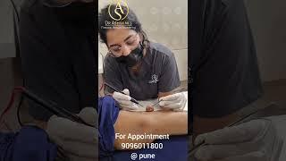 Big Skin Tag Removal  @Pune @naturalbrowsacademyandbeau4299