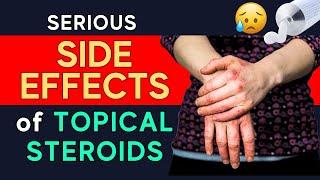 Topical Steroid Skin Side Effects Are REAL (What You Need To Know) | Dr. Luis Franco