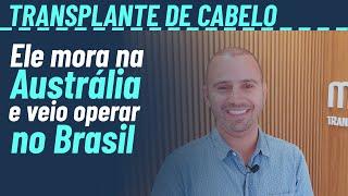 Transplante capilar no Brasil em paciente que mora na Austrália